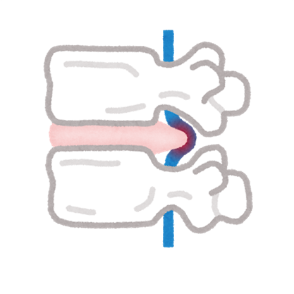 椎間板ヘルニア・椎間板損傷・椎間板障害